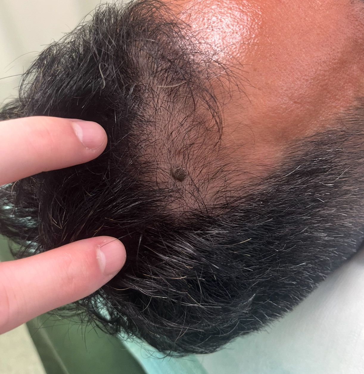 30代男性のM字、前頭部の薄毛　薄毛改善鍼の施術前