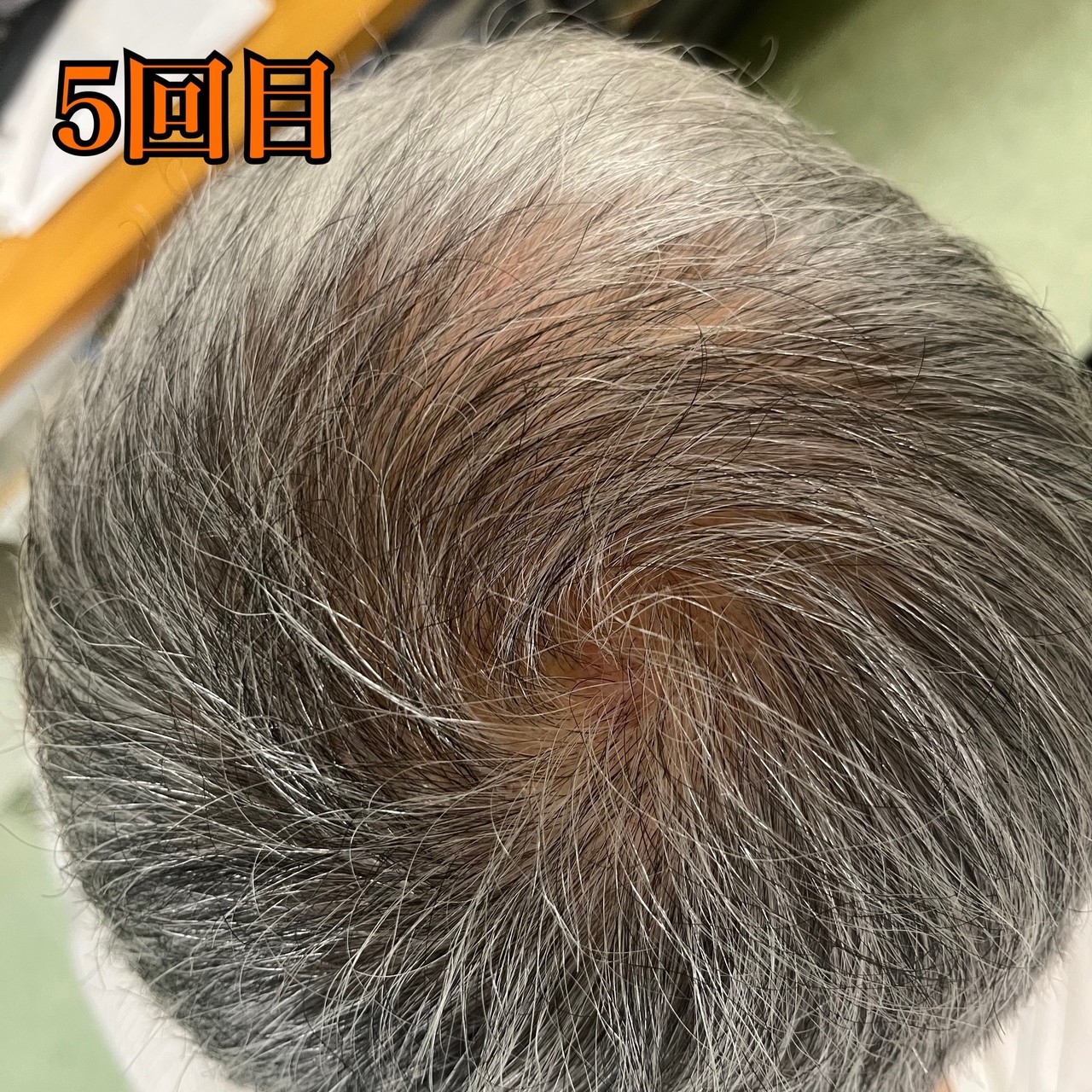 60代男性の頭頂部の薄毛改善鍼　施術後