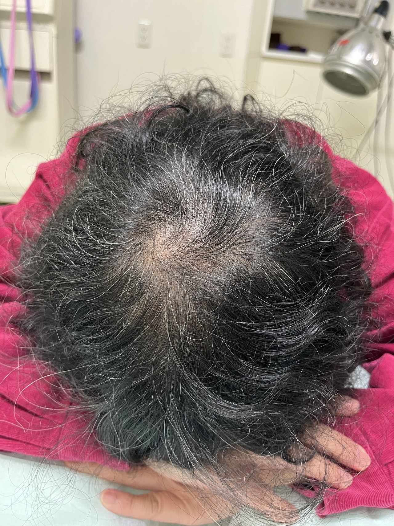 60歳代女性　薄毛改善鍼　頭頂部の施術後　10回目