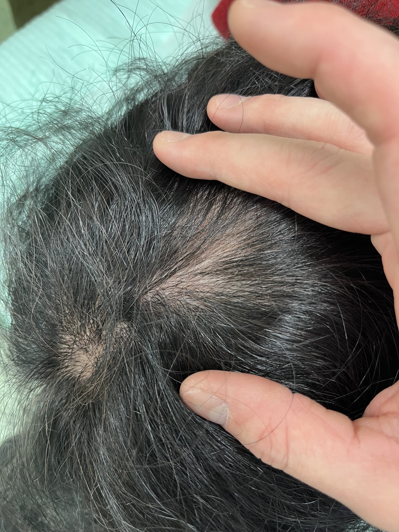 円形脱毛症でお悩みの50歳代女性　薄毛改善鍼　8回目施術後