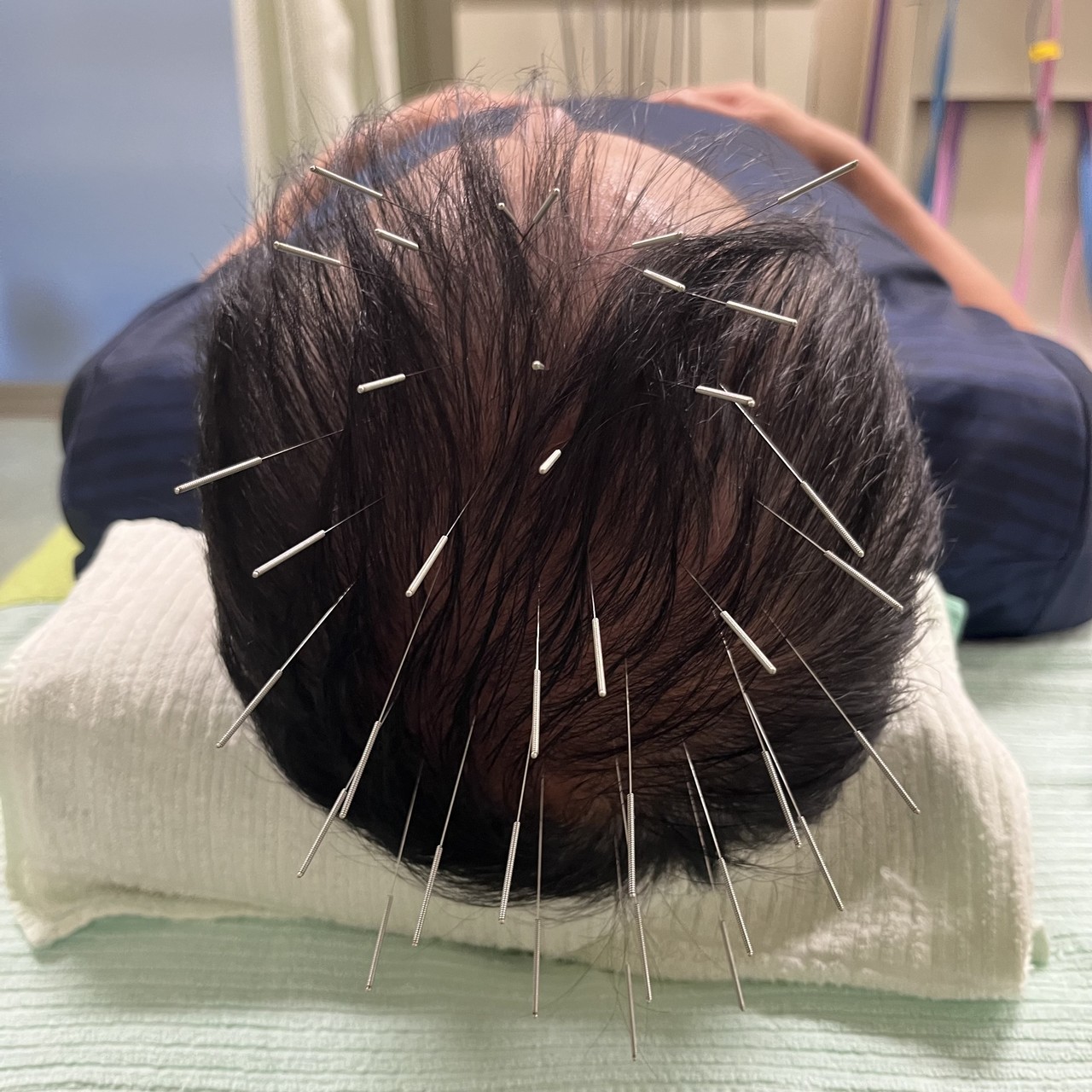 薄毛改善鍼　施術写真