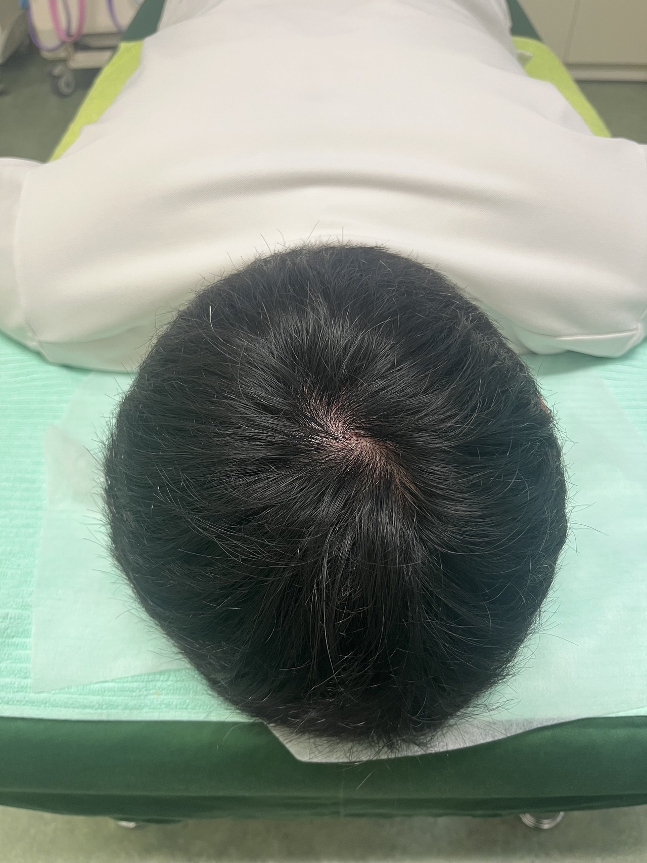 40歳代男性　薄毛改善鍼　頭頂部のAfter