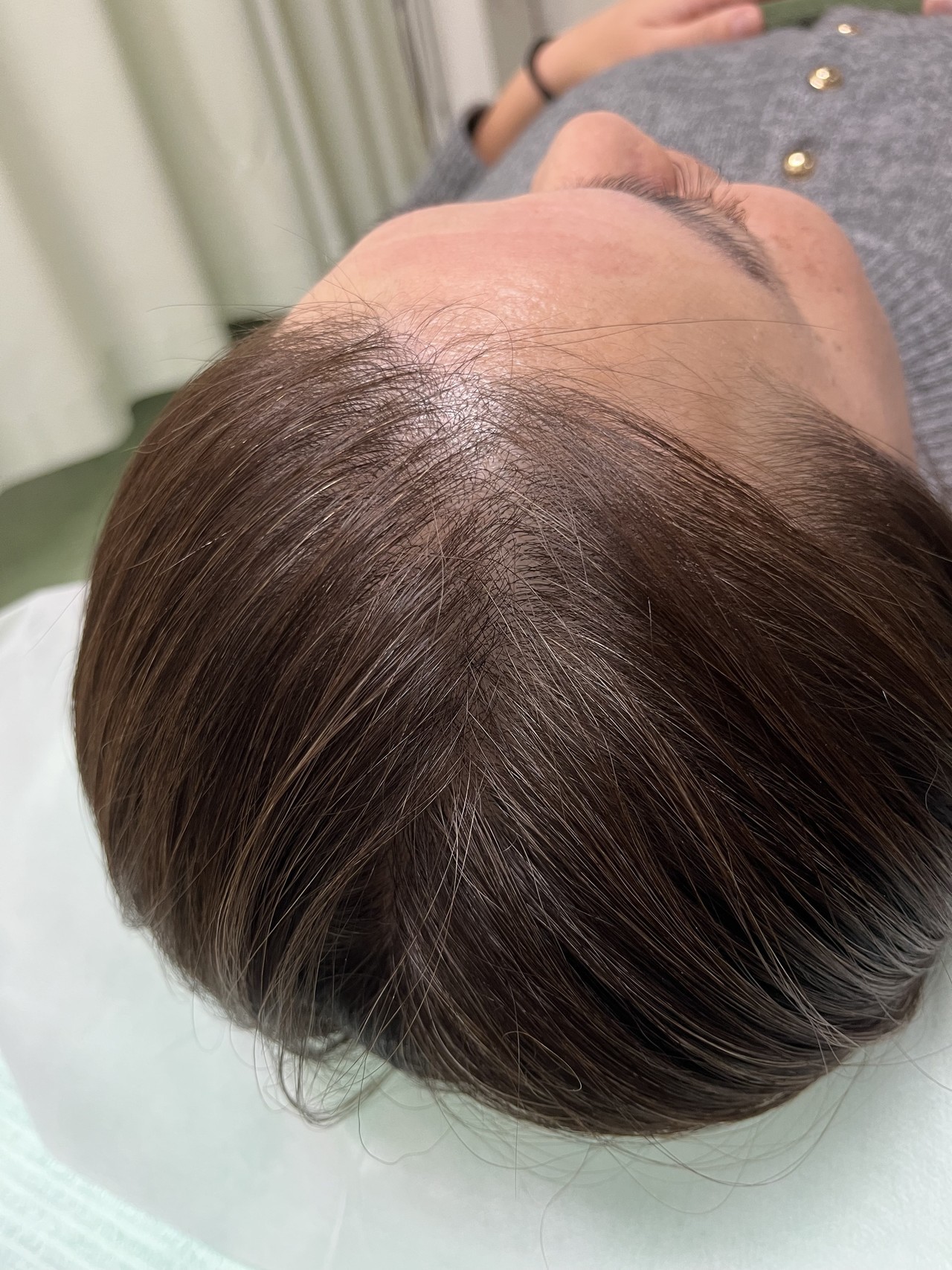 40歳代女性の頭頂部薄毛改善鍼の施術後　4回目