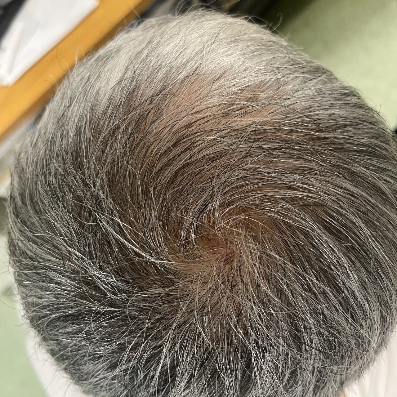 60歳代男性　薄毛改善鍼　頭頂部のAfter