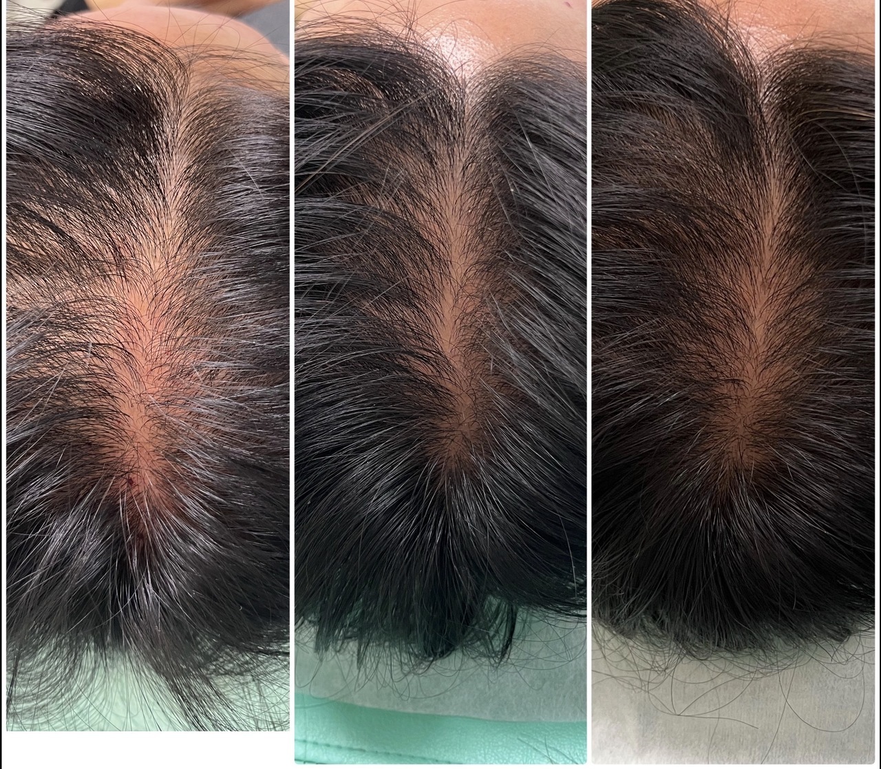 分け目の薄毛に悩んでいた40代女性の育毛鍼を受けたbefore　after　1回目、5回目、10回目の写真