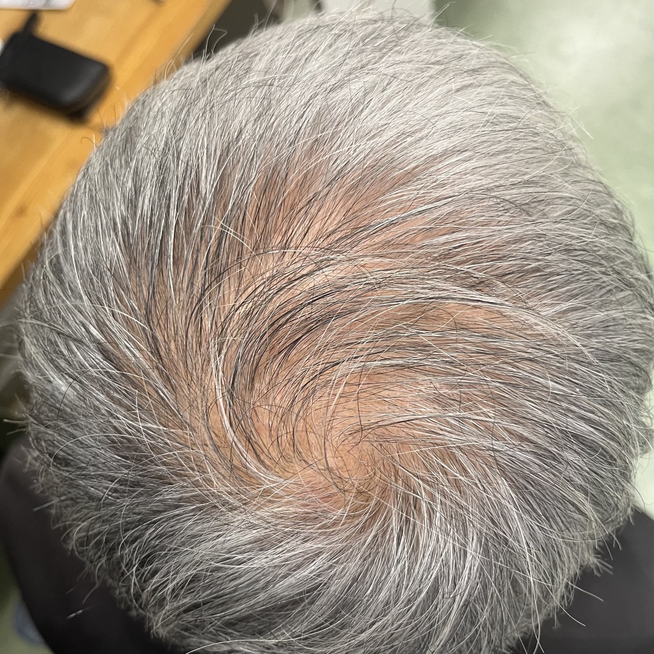 60歳代男性の薄毛改善鍼　頭頂部のBefore