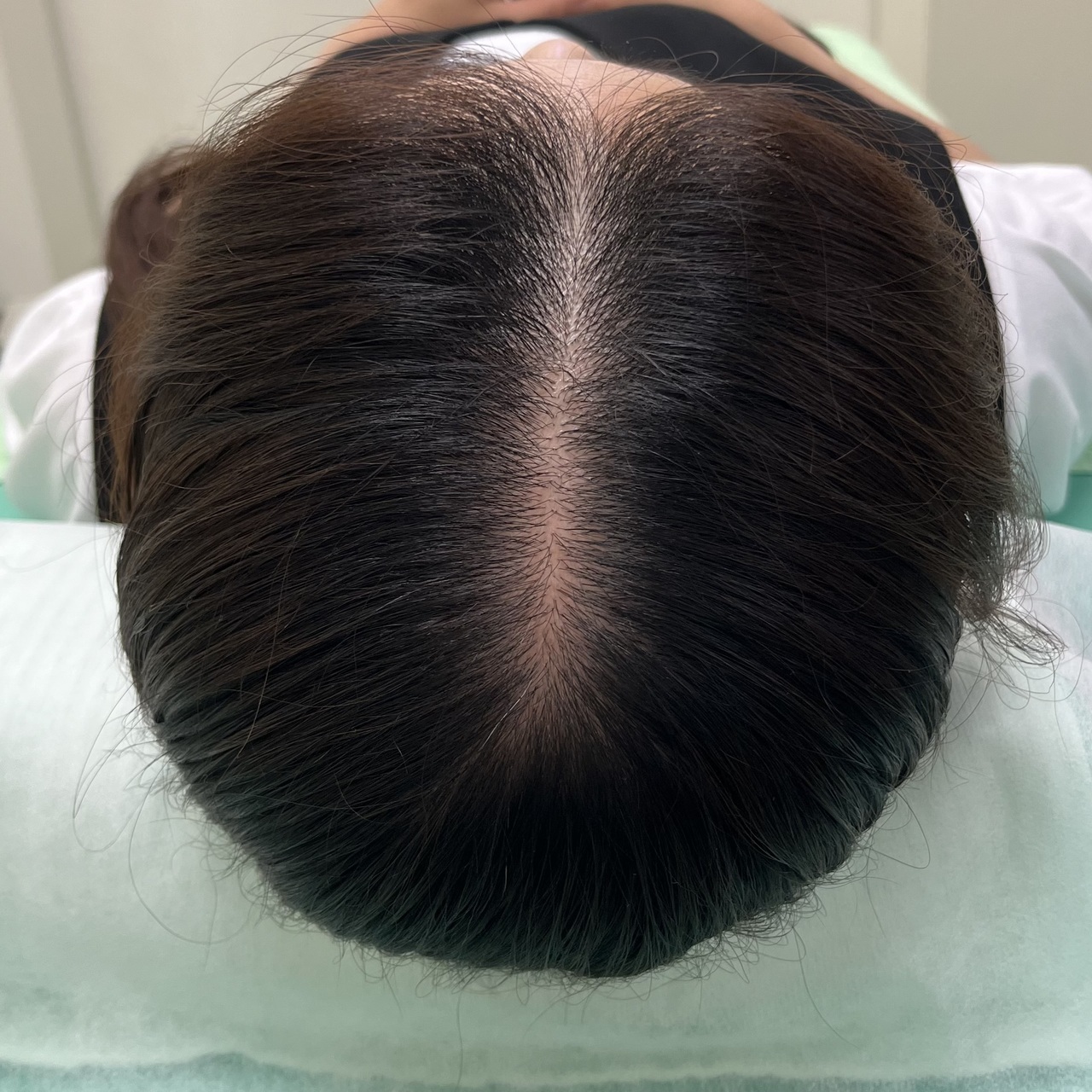 30代男性のM字、前頭部の薄毛　薄毛改善鍼　10回目施術後
