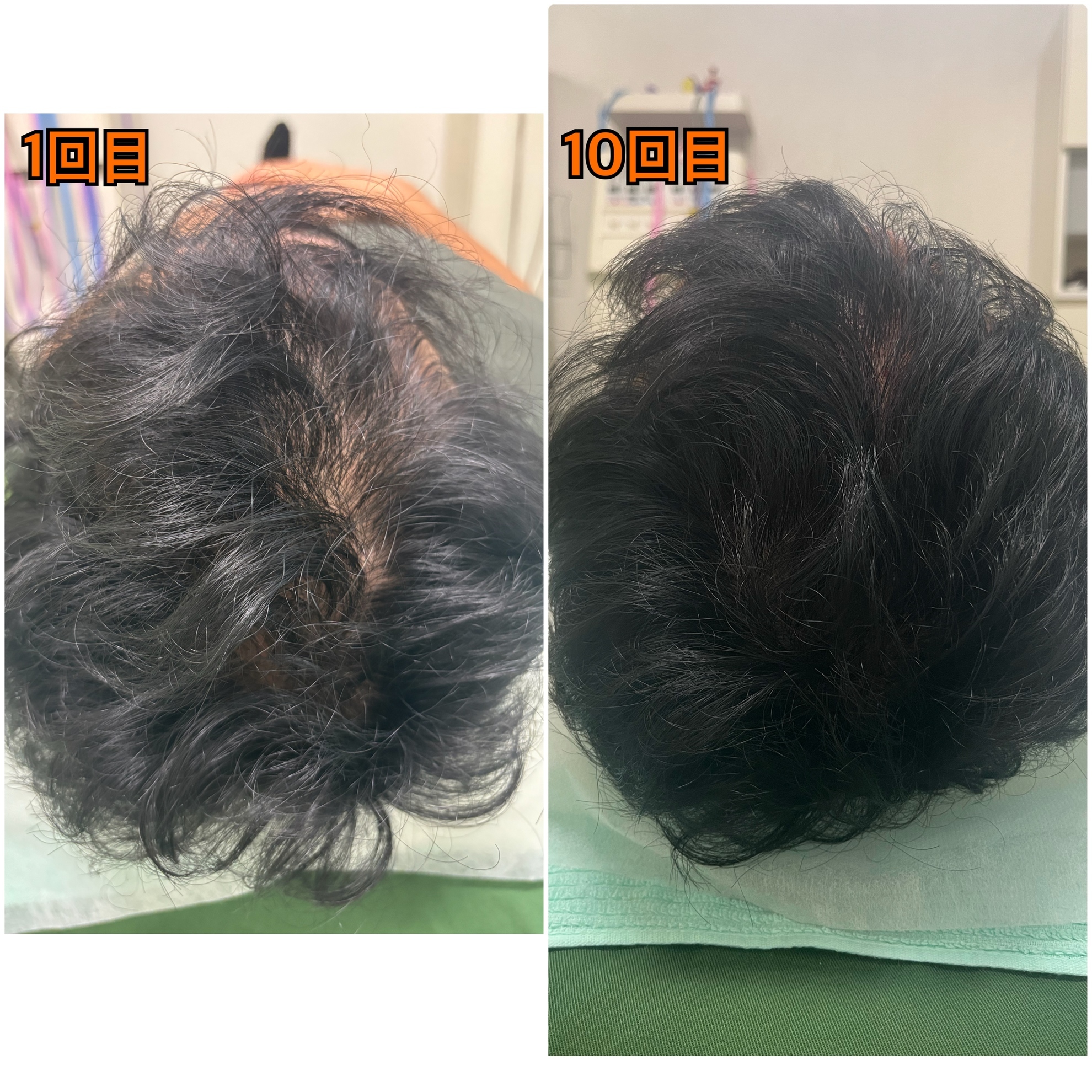 40歳代　男性が薄毛改善鍼を受けて10回目の変化を撮った写真