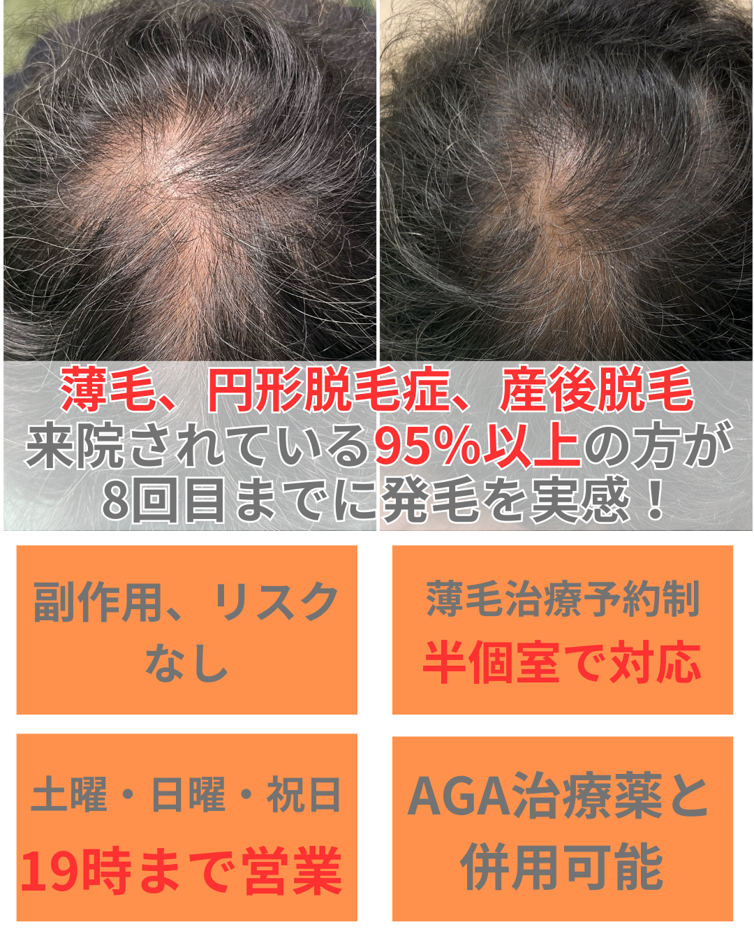 オオヤ鍼灸整骨院　姫路駅前店で受けられる女性の薄毛、円形脱毛症、産後脱毛を改善する薄毛改善鍼