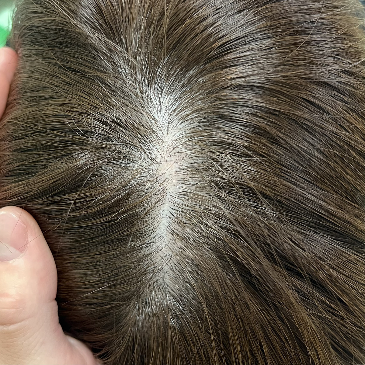 50歳代男性　頭頂部の薄毛、髪の毛の細さが気になる患者さまの1回目　施術前