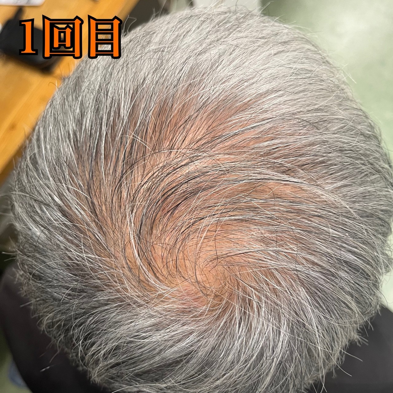 60代男性の頭頂部の薄毛改善鍼の施術前