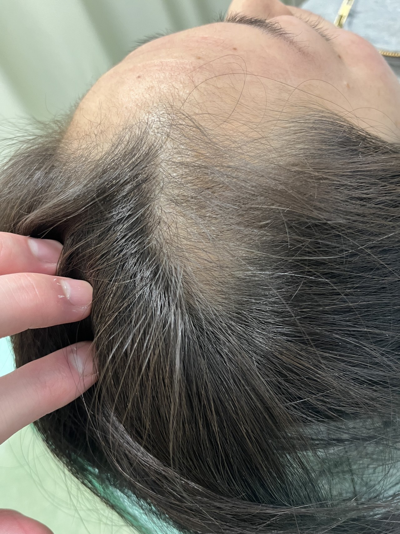 40歳代女性の円形脱毛症　薄毛改善鍼　8回目After