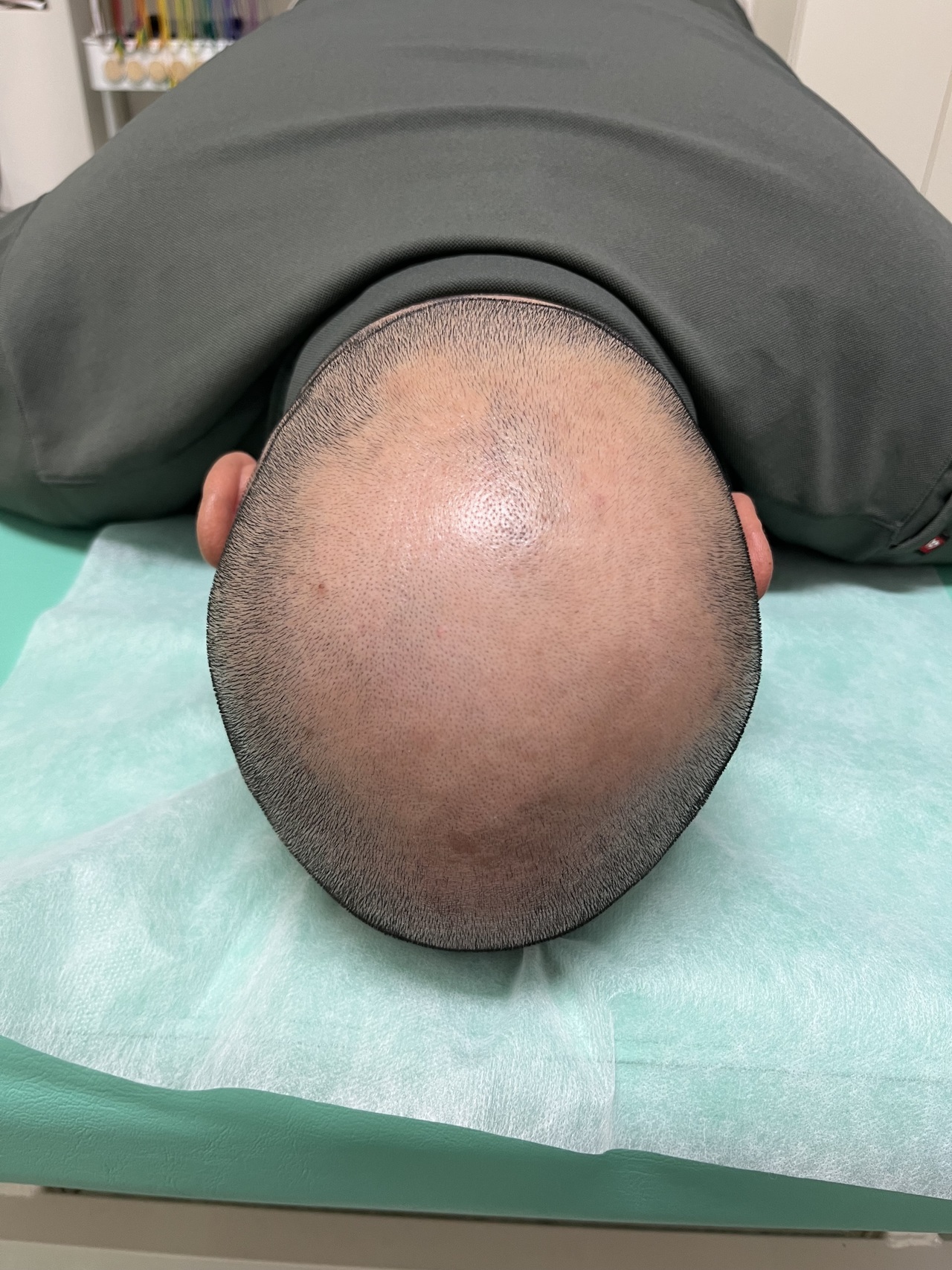 40歳代男性の薄毛改善鍼　頭頂部の薄毛・脱毛症　1回目　Before