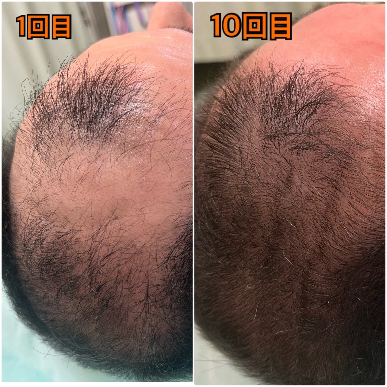 頭頂部の薄毛に悩んでいる50代男性の薄毛改善鍼を受けた1回目、10回目の写真