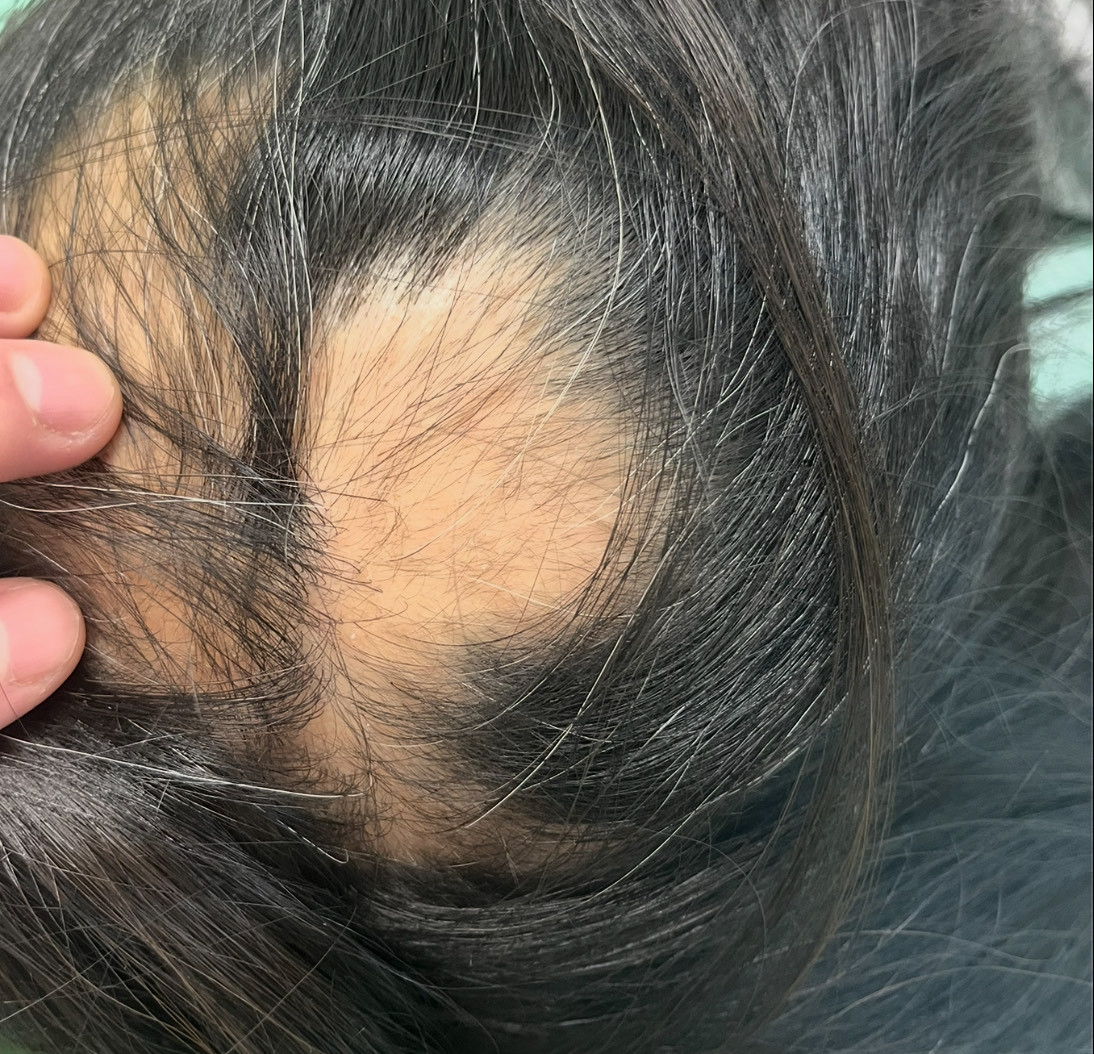 40歳代後半の頭頂部の円形脱毛症　薄毛改善鍼　1回目施術前