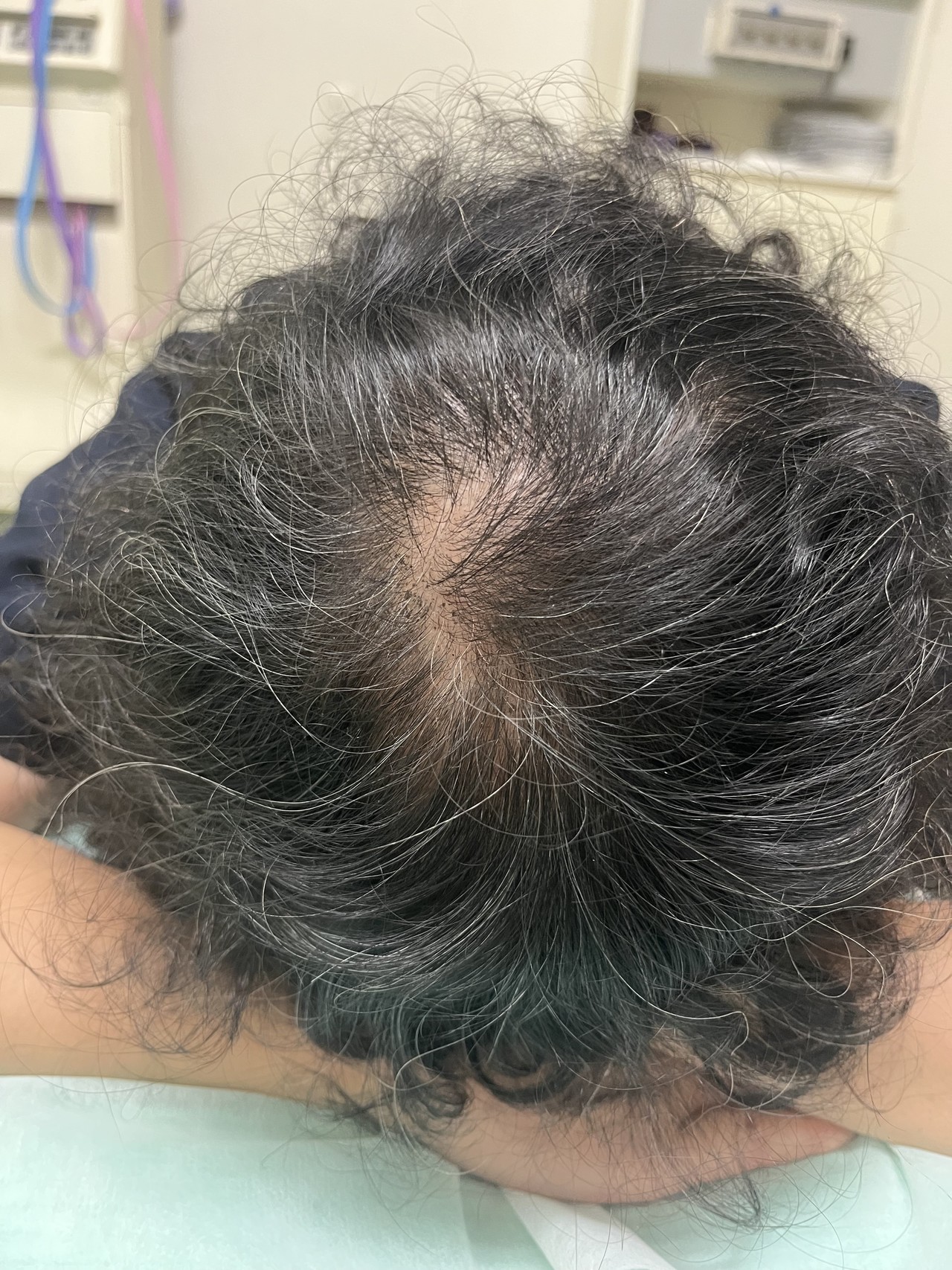 60歳代女性の薄毛改善鍼　頭頂部の施術後　5回目