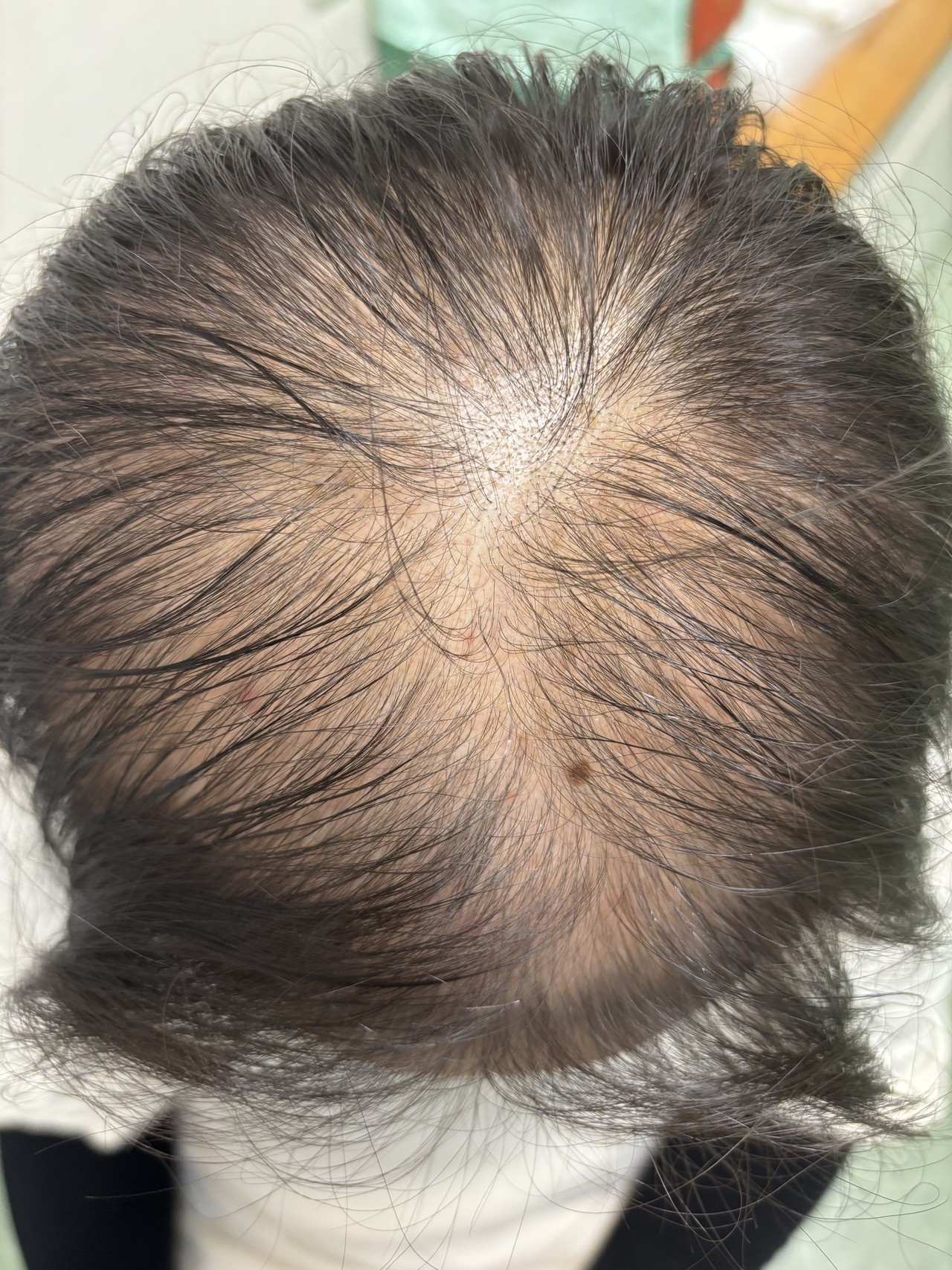 40歳代女性の頭頂部の薄毛改善鍼　1回目施術前