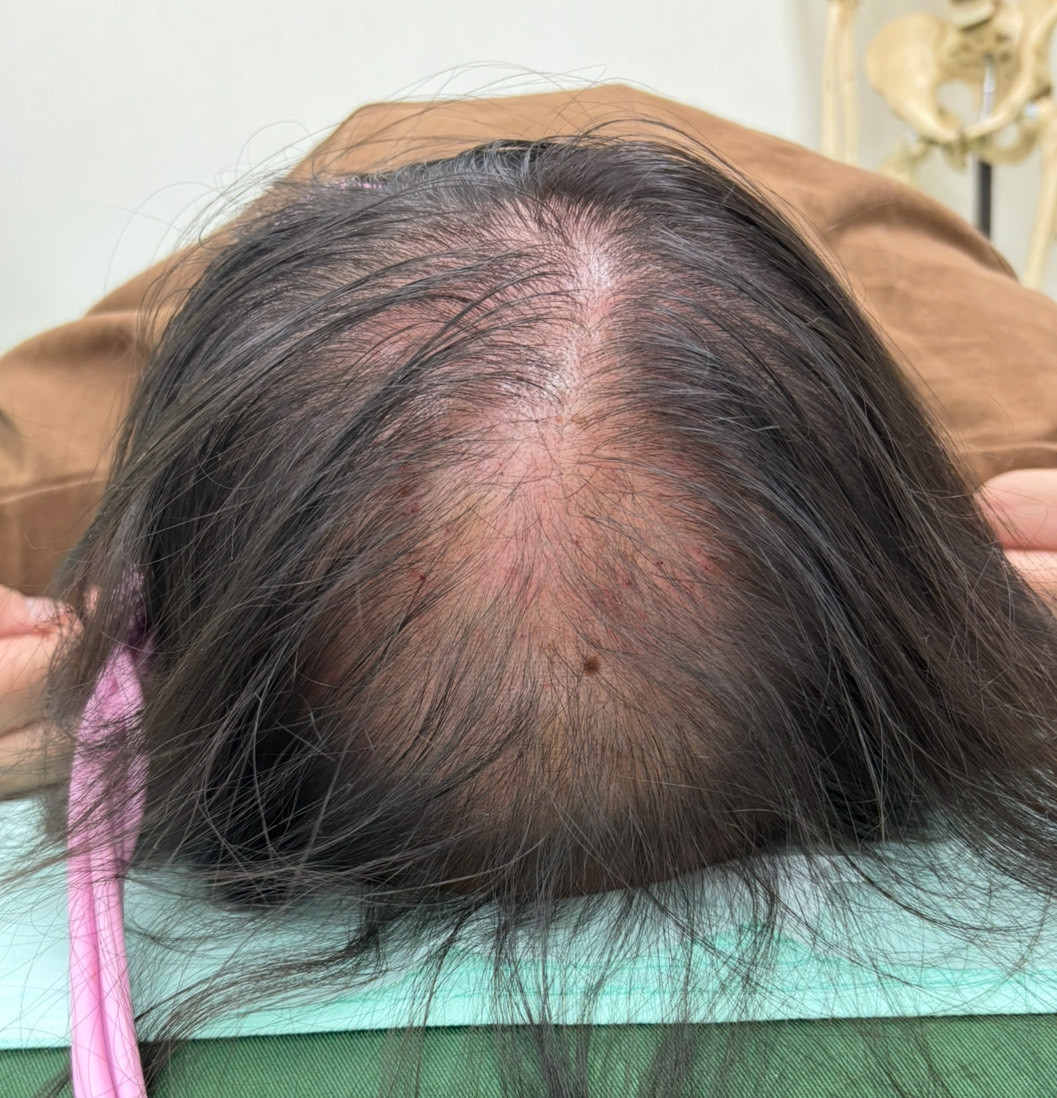 40歳代女性の頭頂部の薄毛改善鍼　4回目施術後
