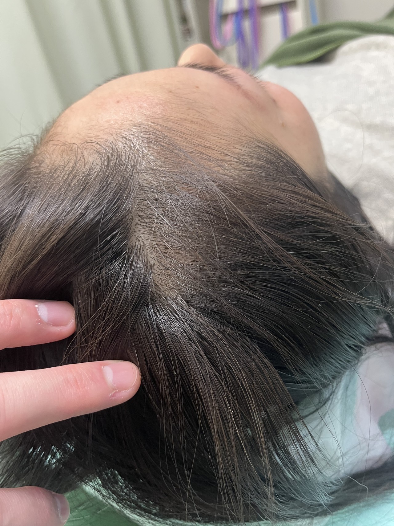 40歳代女性の円形脱毛症　薄毛改善鍼　10回目After