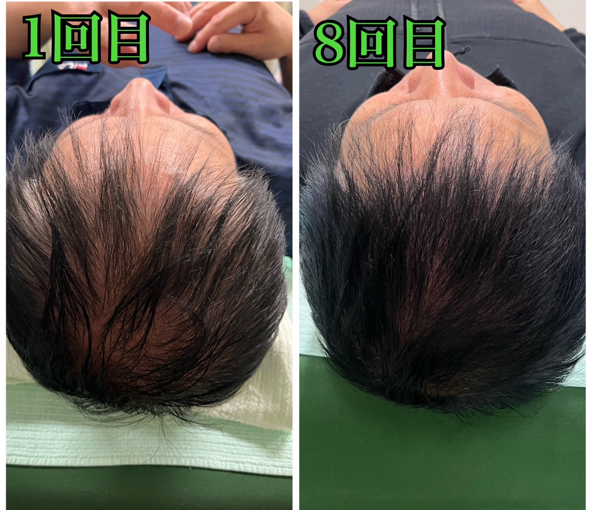 男性の薄毛、AGAに悩んでいる方の薄毛改善鍼の1回目から8回目を受けた写真