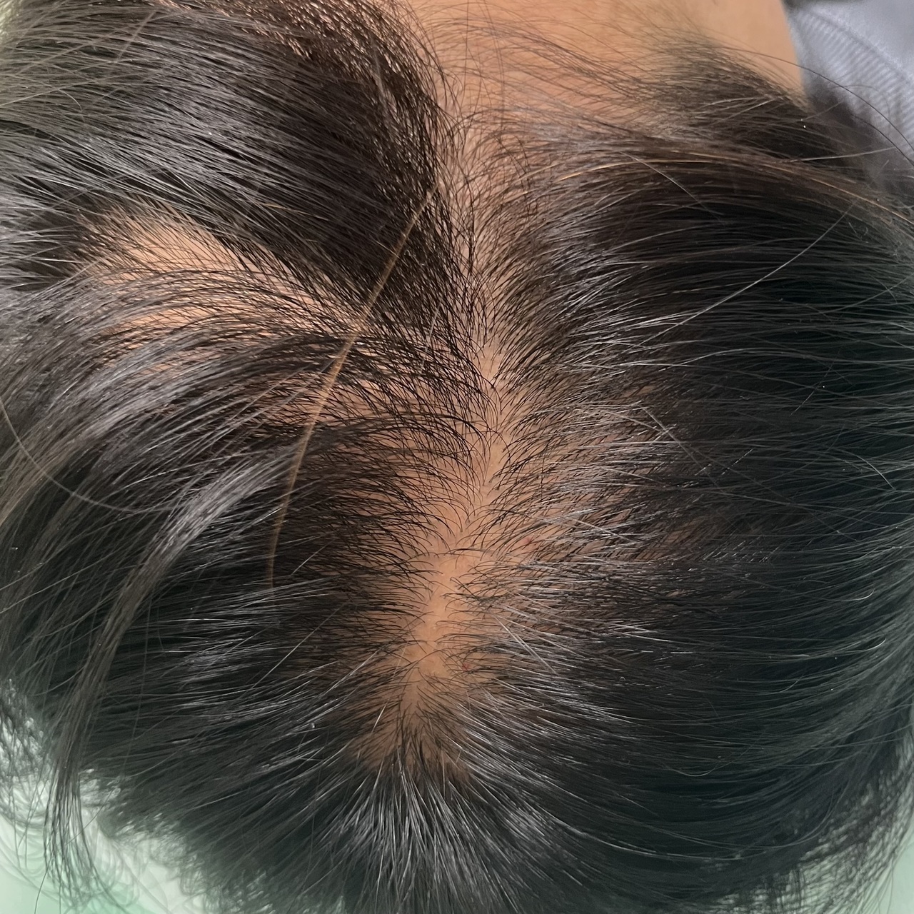 40歳代女性の育毛鍼・薄毛改善鍼　頭頂部の施術後　4回目