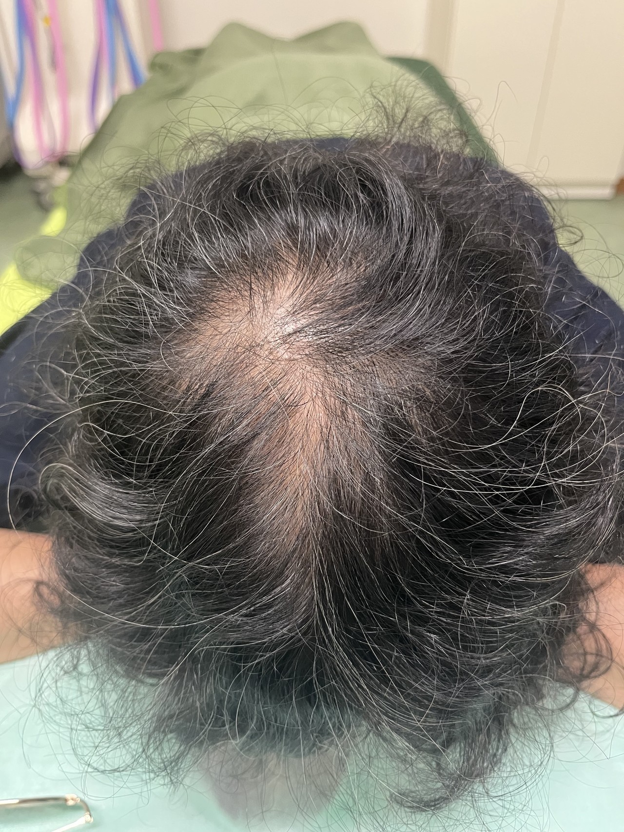 60歳代前半女性　薄毛改善鍼　頭頂部の施術前　1回目