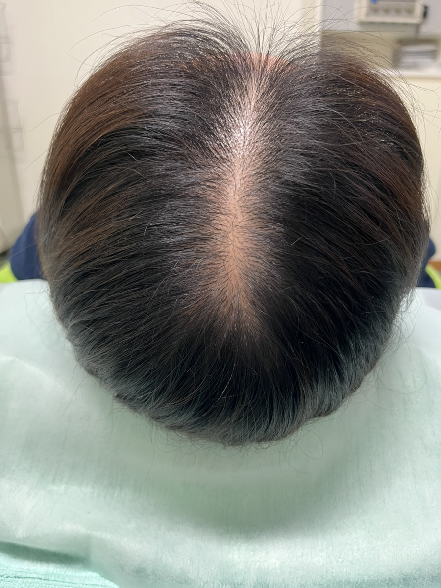 40代女性の頭頂部の分け目の薄毛　薄毛改善鍼の施術前