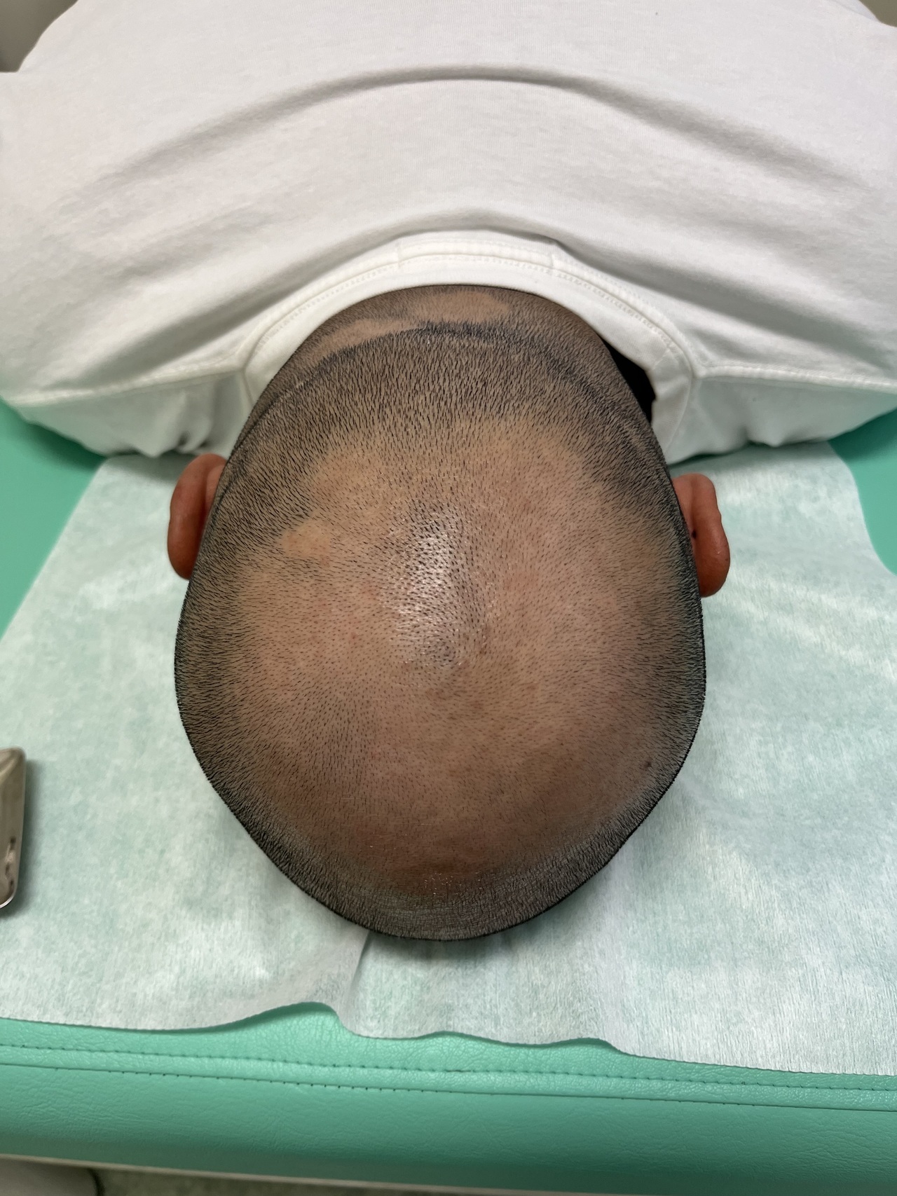 40歳代男性の薄毛改善鍼　頭頂部の薄毛・脱毛症　5回目　After