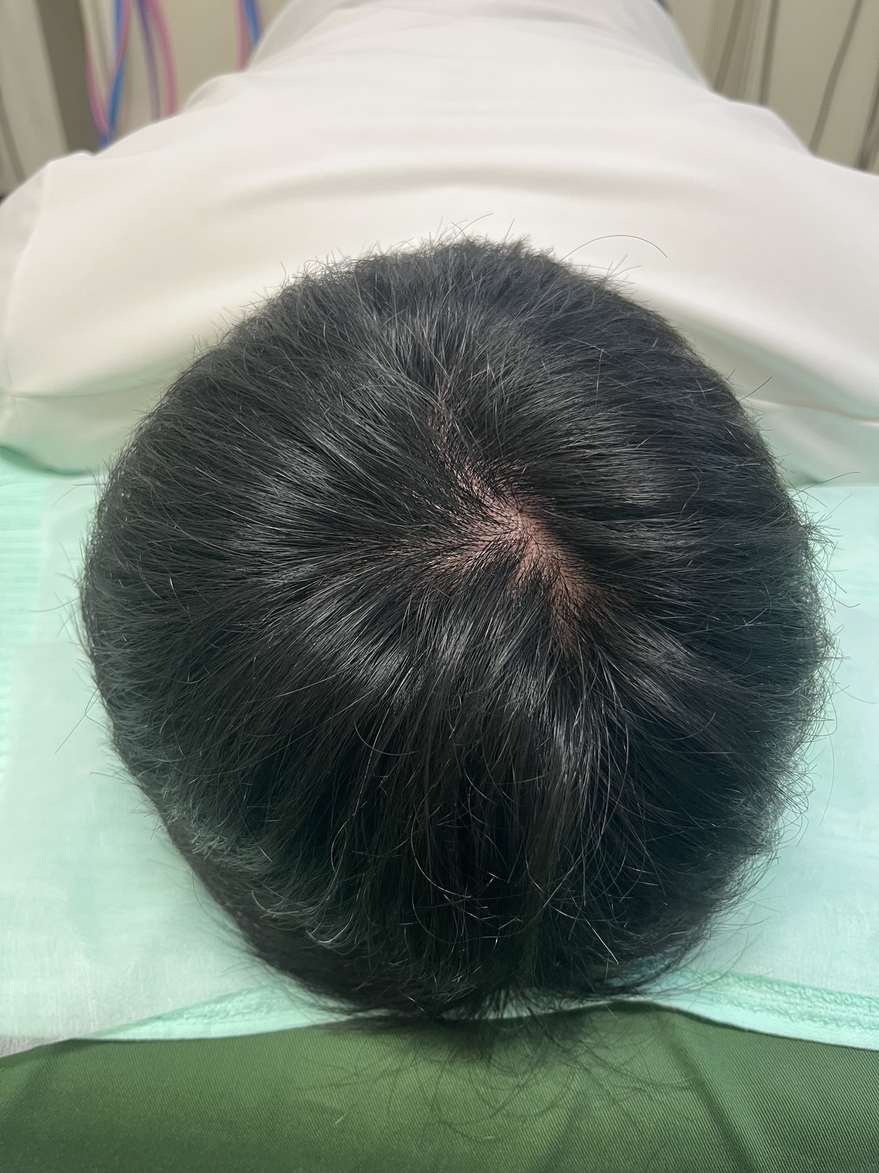 40歳代男性の薄毛改善鍼　頭頂部のAfter