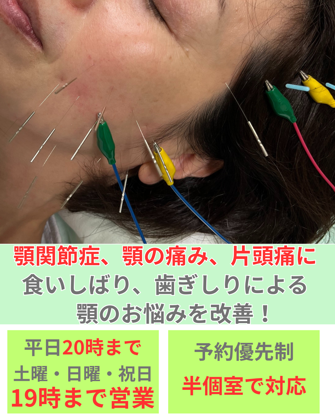 オオヤ鍼灸整骨院　姫路駅前店の顎関節症改善メニュー　顎の痛み、食いしばりによる顎のお悩みを鍼治療で徹底改善！