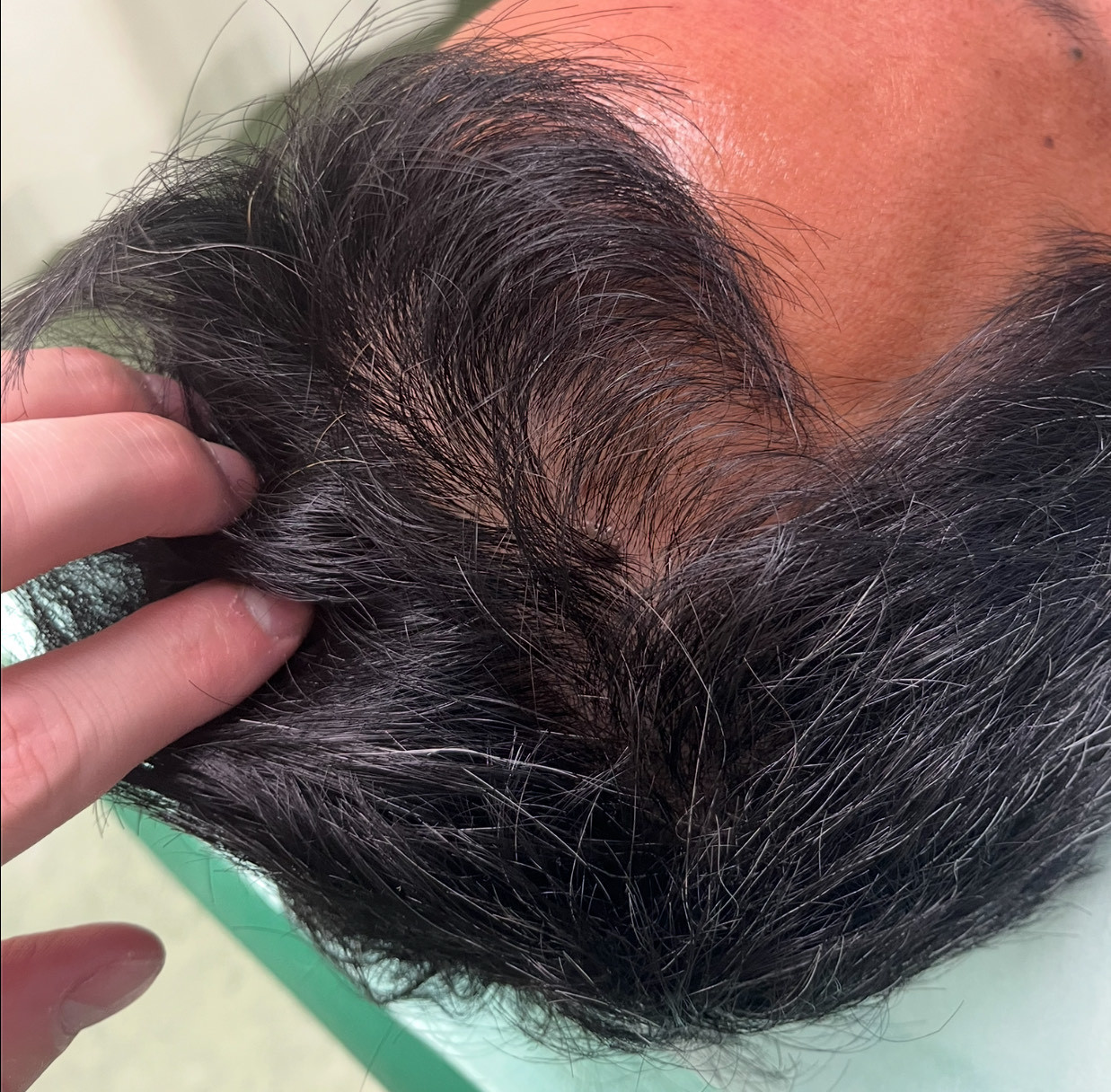 30代男性のM字、前頭部の薄毛　薄毛改善鍼　10回目施術後