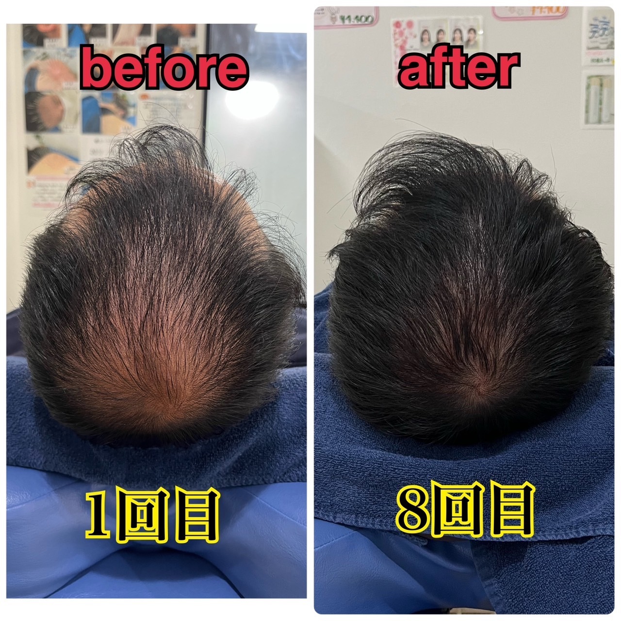 薄毛改善鍼　before After　頭のてっぺんが8回目で髪の毛が生えてきた