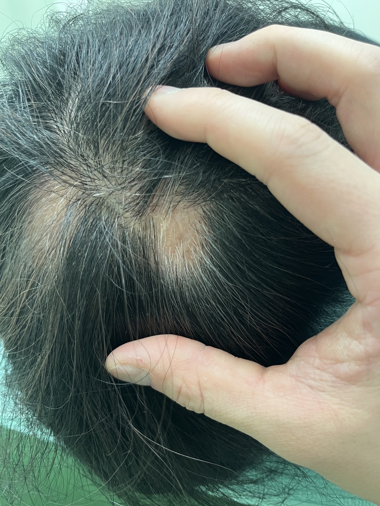 円形脱毛症でお悩みの50歳代女性　薄毛改善鍼の施術前