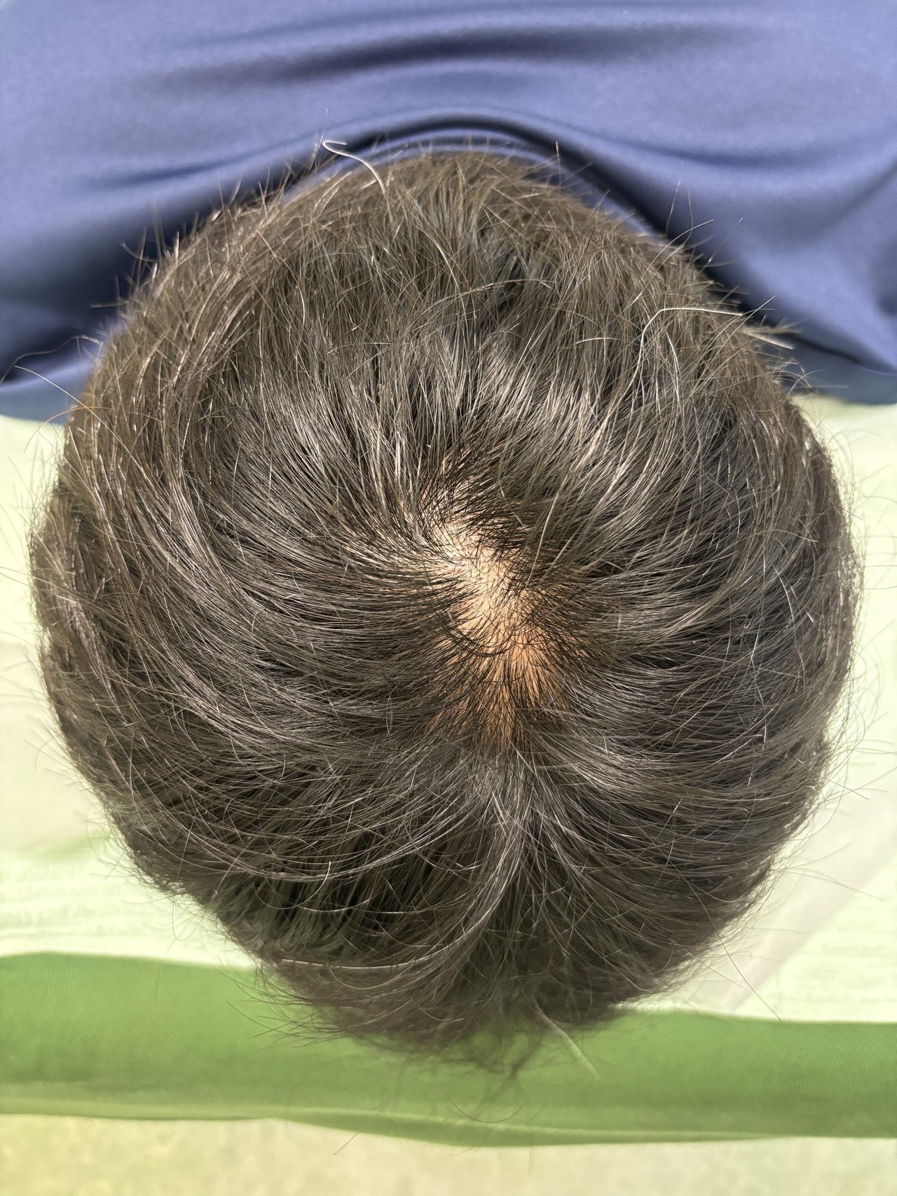 40歳代男性の薄毛改善鍼の頭頂部Before