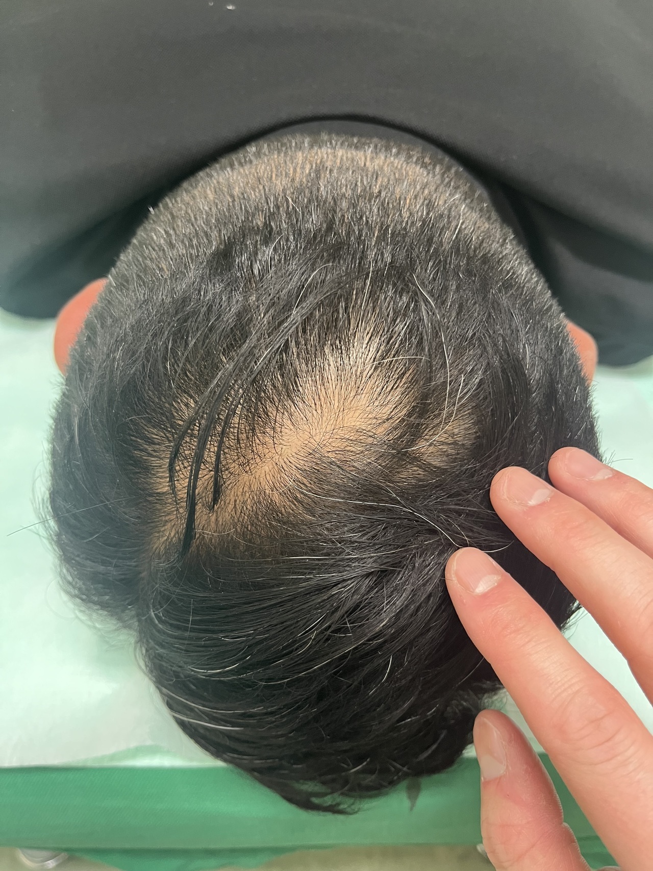 50歳代男性　頭頂部の薄毛、髪の毛の細さが気になる患者さまの1回目　施術前