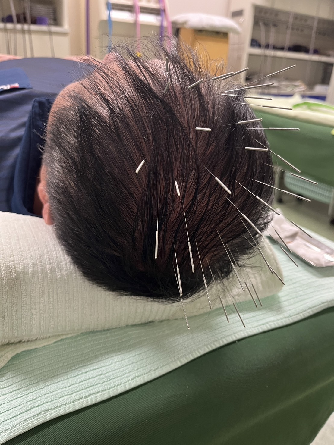辛い頭痛、肩こりや首こりからくる頭痛を鍼の力で改善する治療
