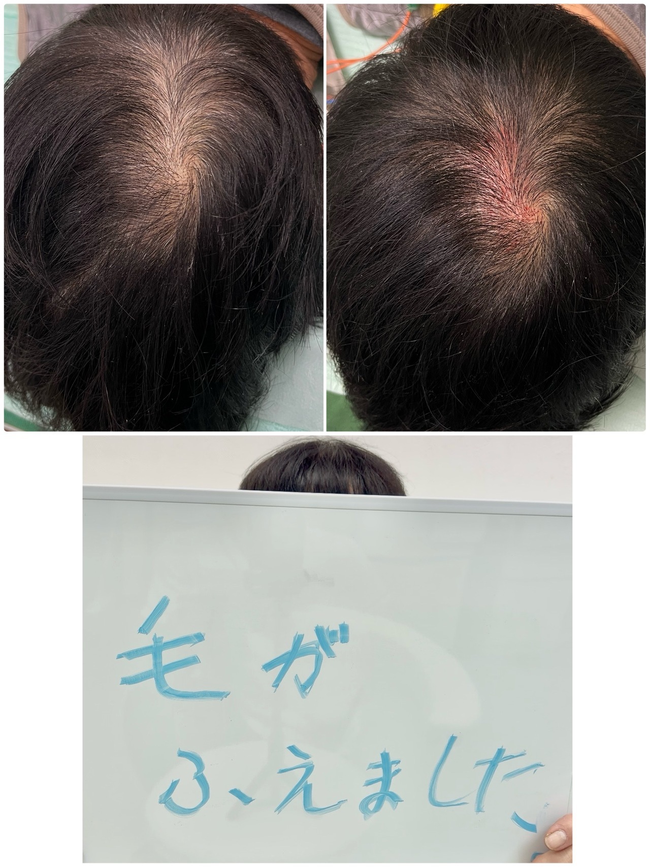 頭頂部の薄毛で来院されている60代女性のお客様の声