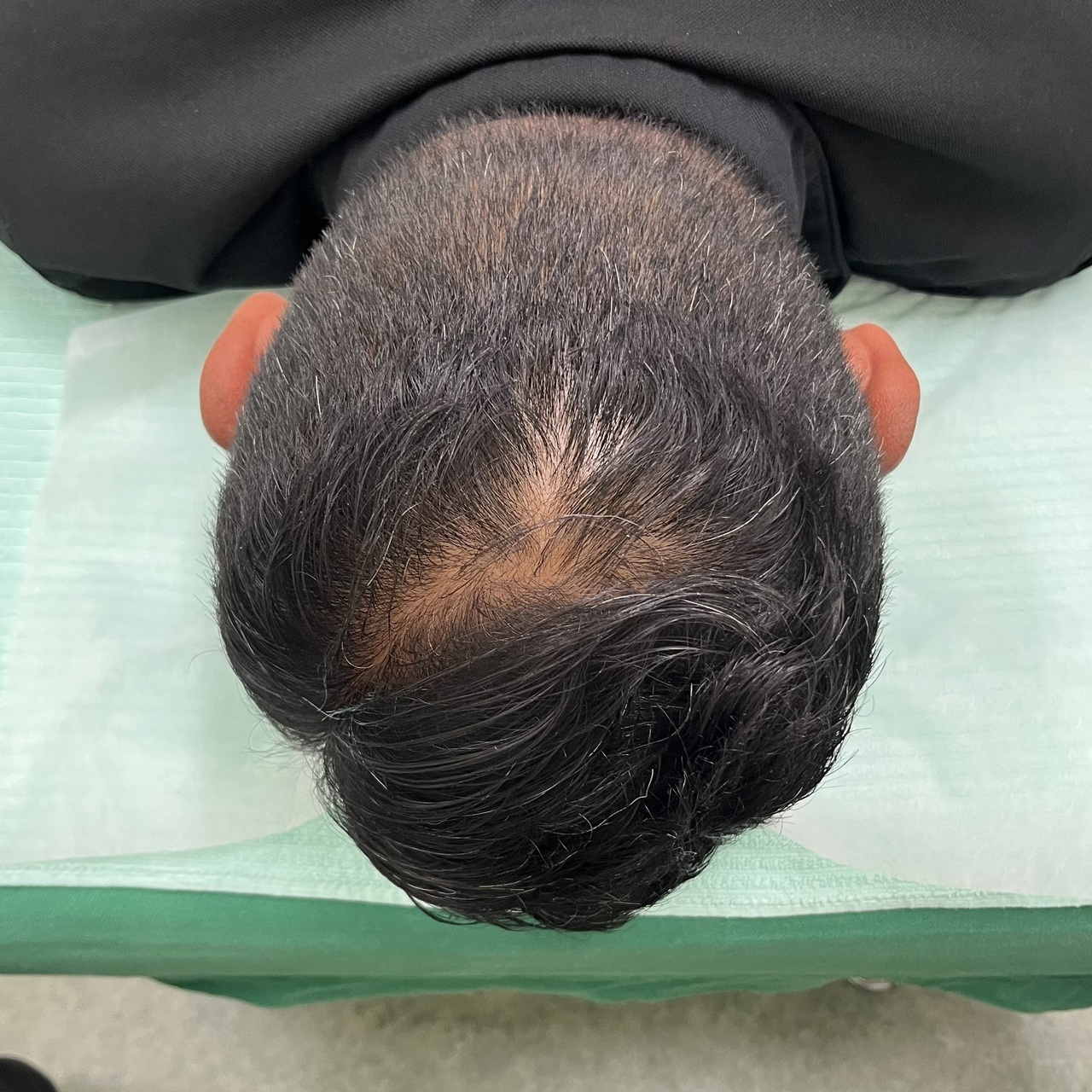 50歳代男性　頭頂部の薄毛、髪の毛の細さが気になる患者さまの8回目　施術後