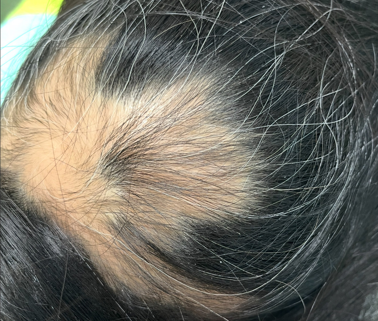 40歳代後半の頭頂部の円形脱毛症　薄毛改善鍼　8回目施術後