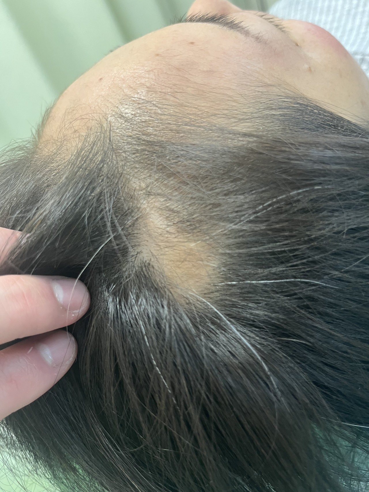 40歳代女性の円形脱毛症　薄毛改善鍼のBefore