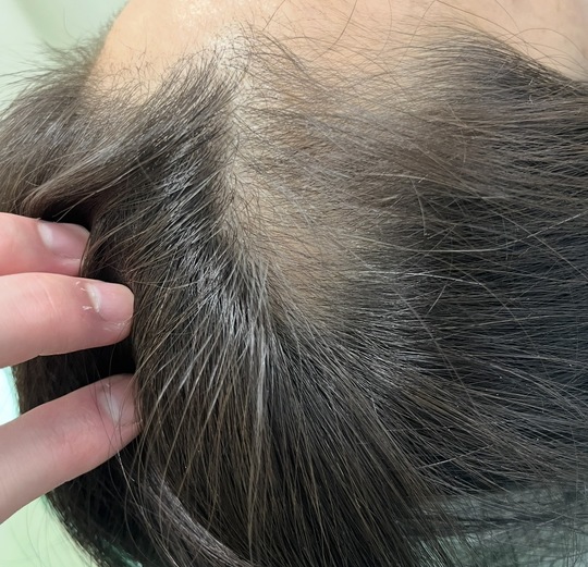 40歳代女性の円形脱毛症　薄毛改善鍼　8回目After