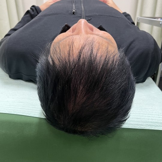 50代男性の薄毛改善鍼の施術後