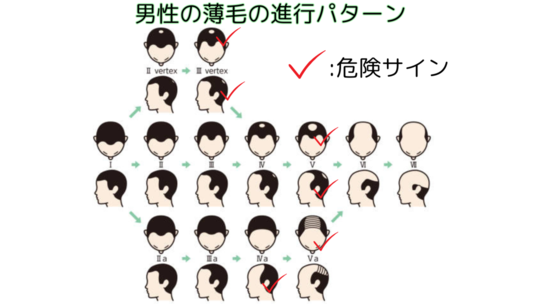 薄毛の進行パターン