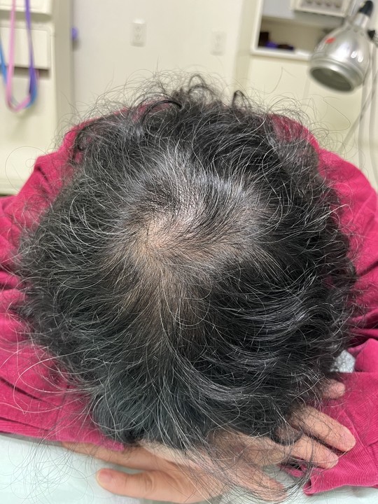 60歳代女性　薄毛改善鍼　頭頂部の施術後　10回目