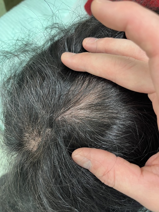 円形脱毛症でお悩みの50歳代女性　薄毛改善鍼　8回目施術後