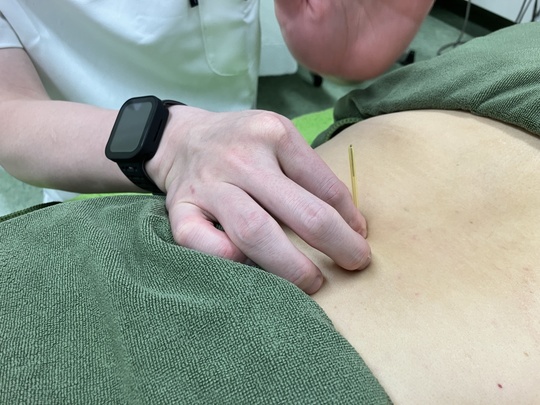 ぎっくり腰になった50代男性の腰へ鍼を打っている写真