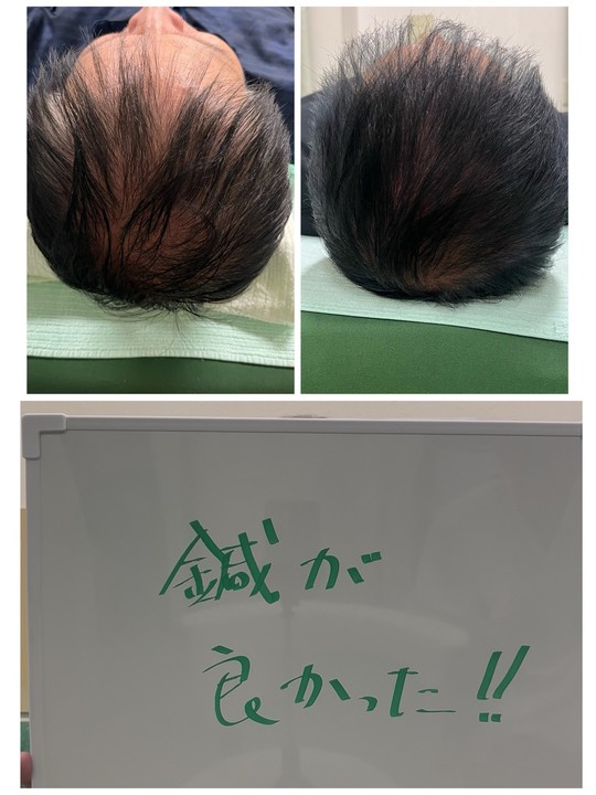 前髪、生え際の薄毛で来院されている50代男性のお客様の声