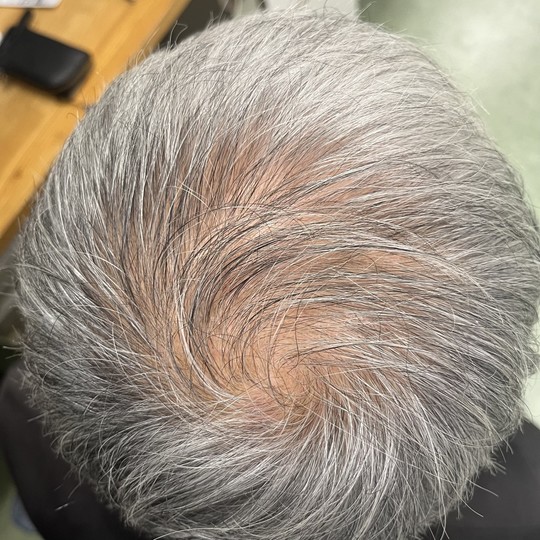 60歳代男性の薄毛改善鍼　頭頂部のBefore