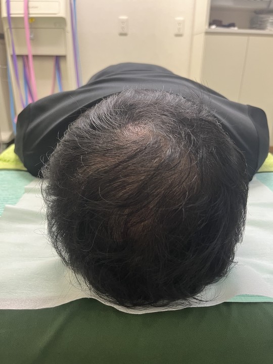 40代男性の薄毛改善鍼の施術後