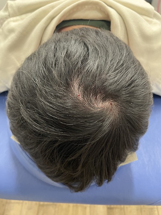 30代男性の頭頂部薄毛改善鍼の施術前